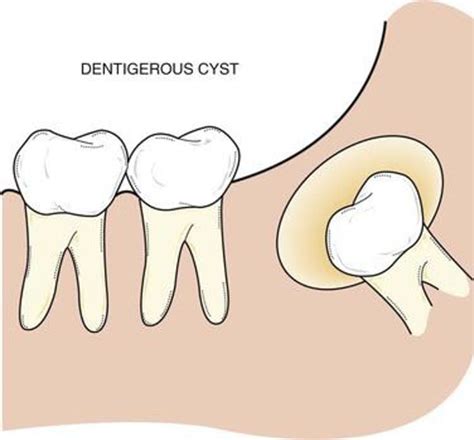 What Causes Dentigerous Cyst